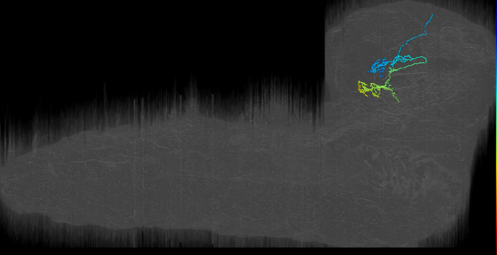 DPM contralateral horseshoe right (L1EM:3021609)
