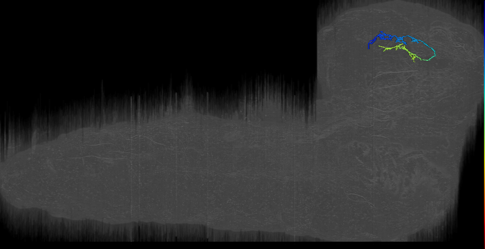 DPLm1 contralateral 1 right; Bilateral DS Smash (L1EM:9288827)