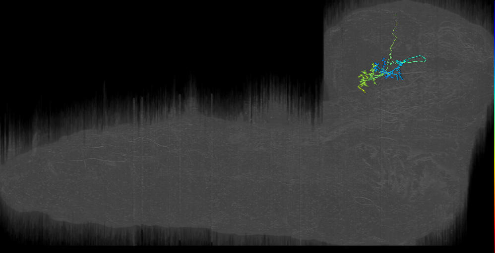 DPM contralateral horseshoe left (L1EM:17354414)