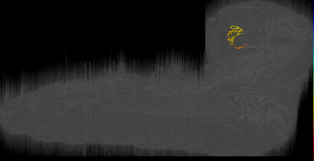 BLAd lat 1 neuron 8842221_sibling left **MISSING DENDRITE** (L1EM:17962513)